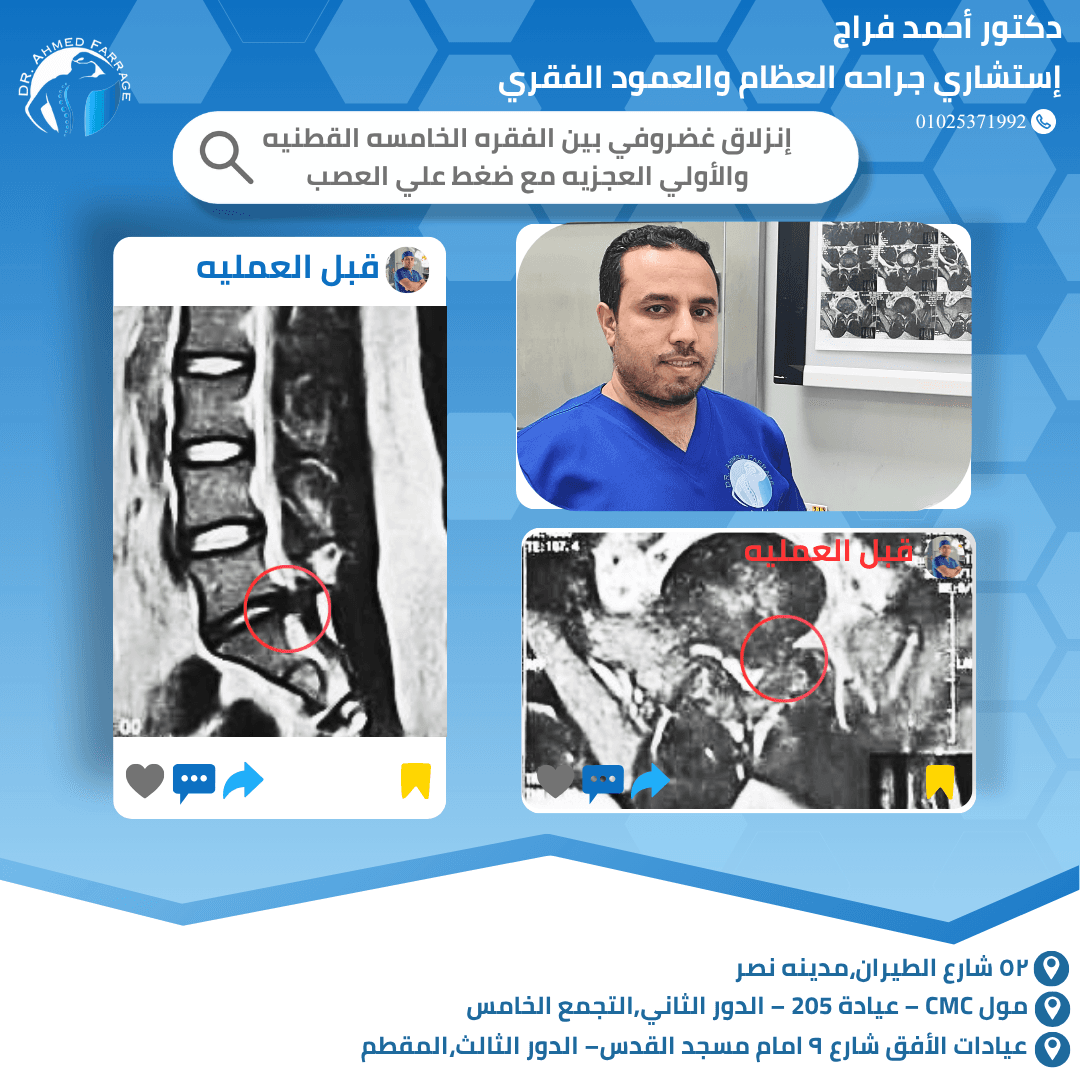 إنزلاق غضروفي بين الفقره الخامسه القطنيه والأولى العجزيه مع ضغط علي العصب 