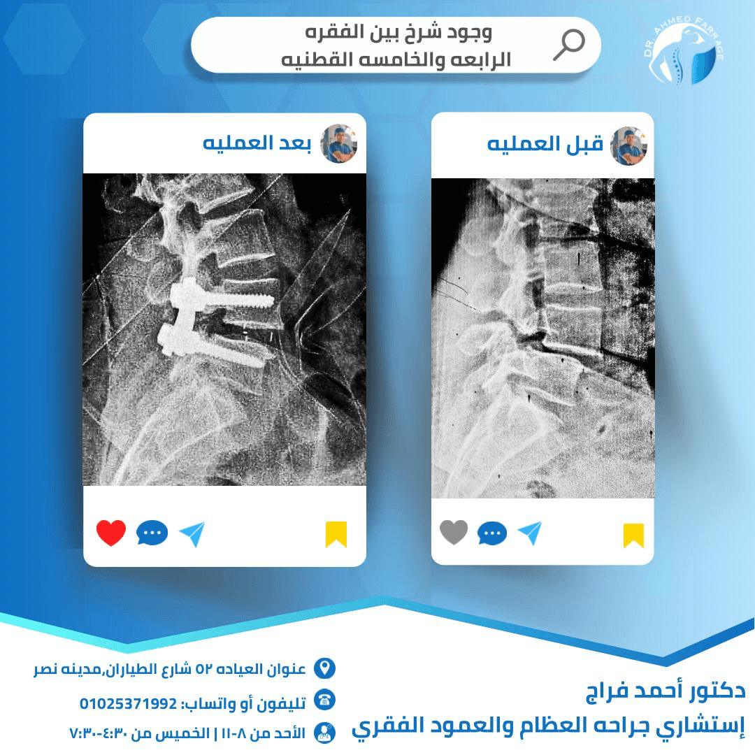 وجود شرخ في العمود الفقري