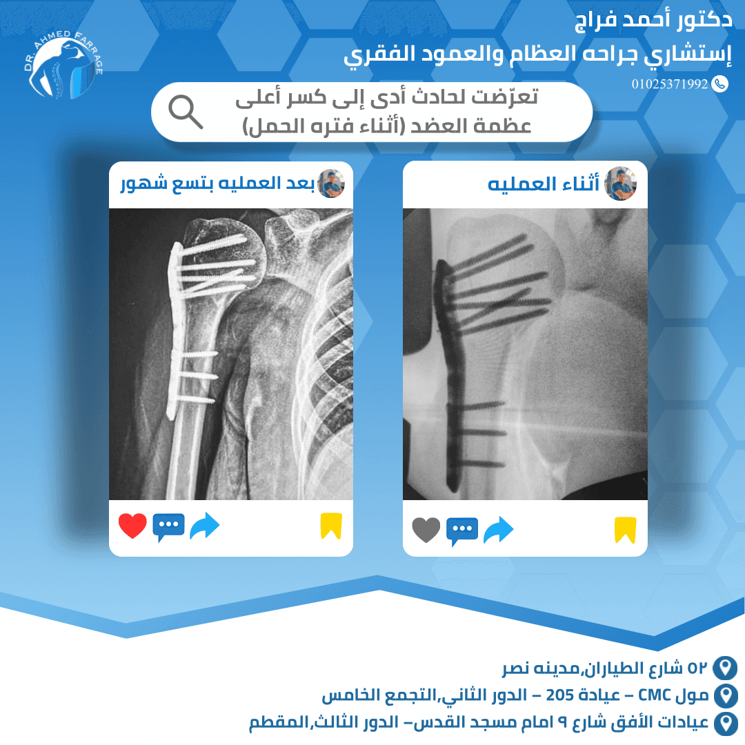 تعرضت لحادث أدي إلى كسر أعلي عظمه العضد (أثناء فتره الحمل)