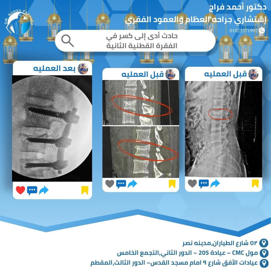 كسر في الفقرة القطنية الثانية