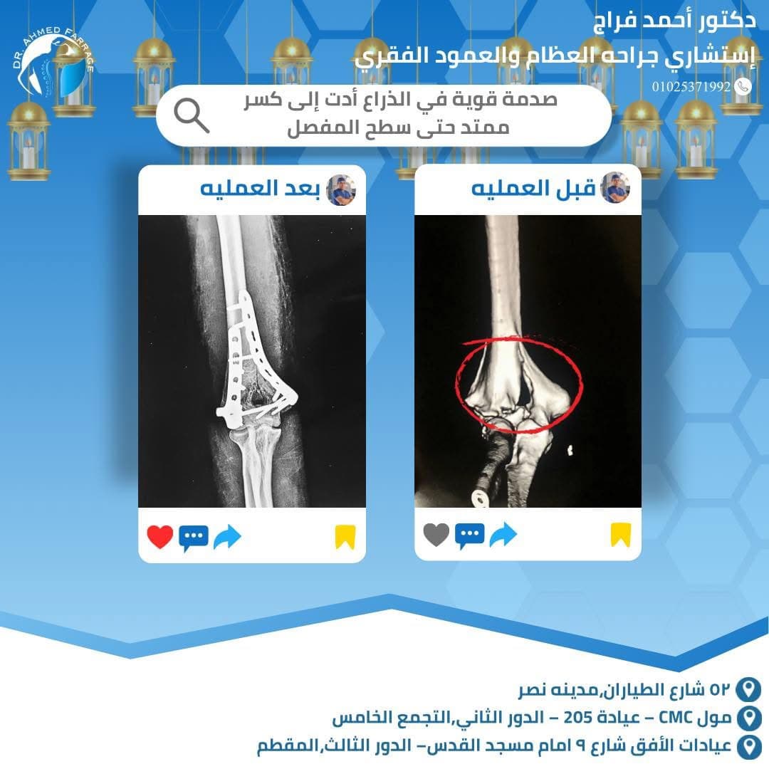 كسر ممتد لسطح مفصل الكوع