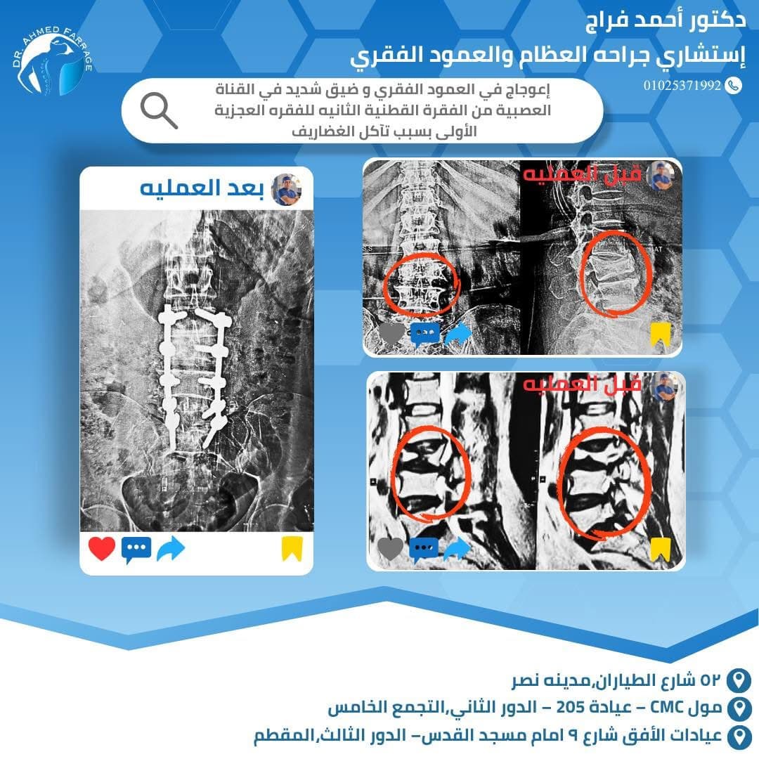 إعوجاج في العمود الفقري وضيق شديد في القناه العصبيه 