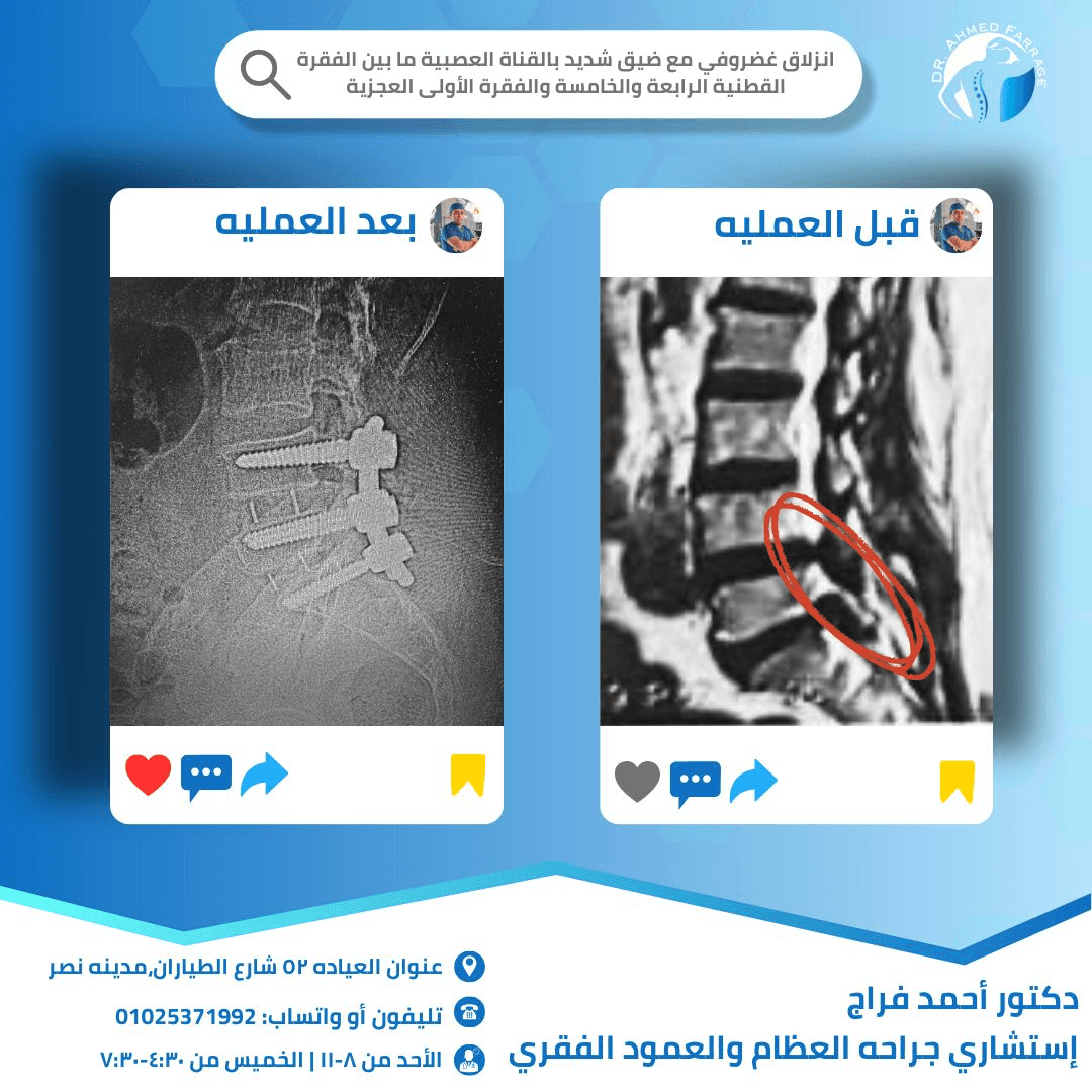 إنزلاق غضروفي مع ضيق شديد بالقناة العصبية