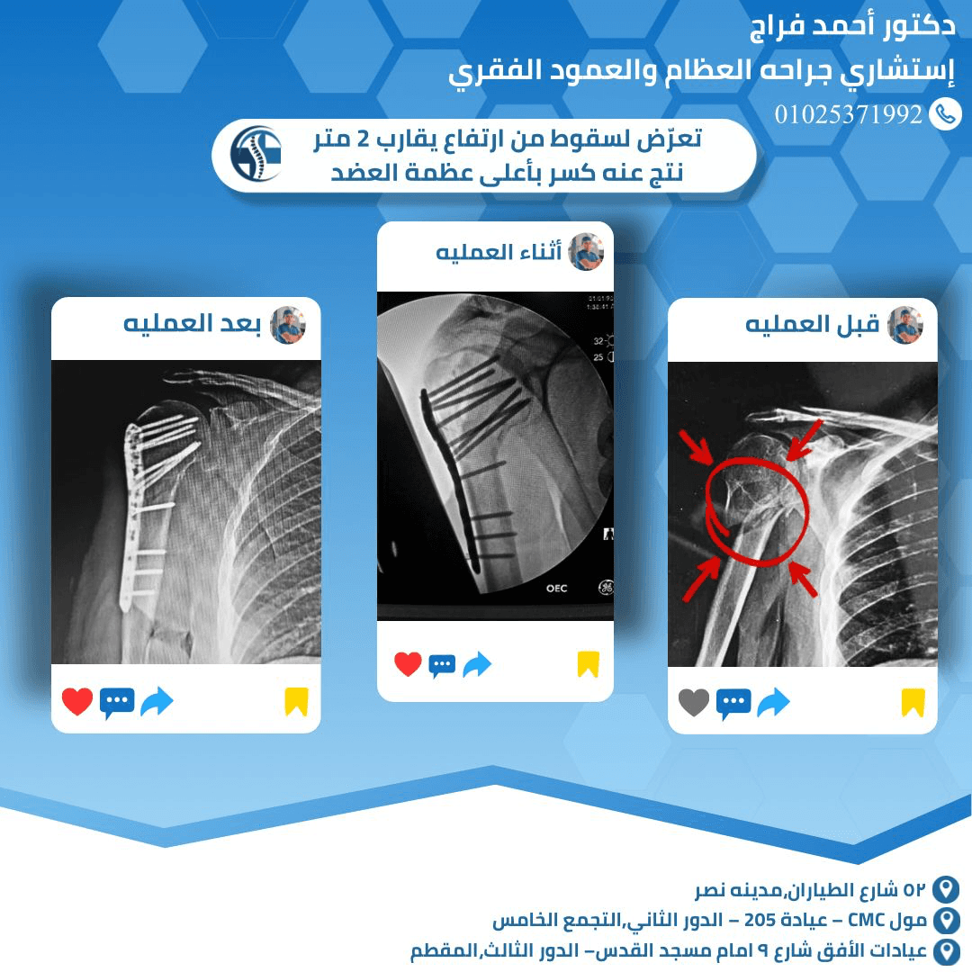 تعرّض لسقوط من ارتفاع يقارب 2 متر نتج عنه كسر بأعلى عظمة العضد