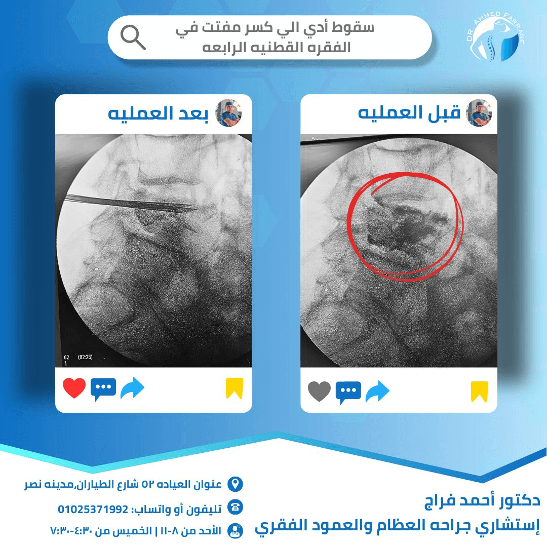 سقوط أدي الي كسر مفتت في الفقره القطنيه الرابعه