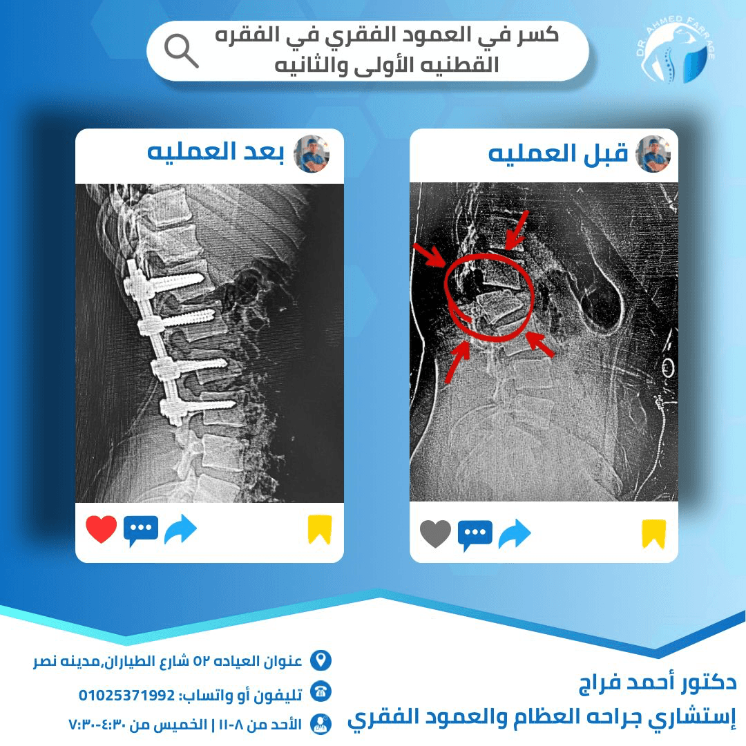 كسر في العمود الفقري في الفقره القطنيه الأولي والثانيه