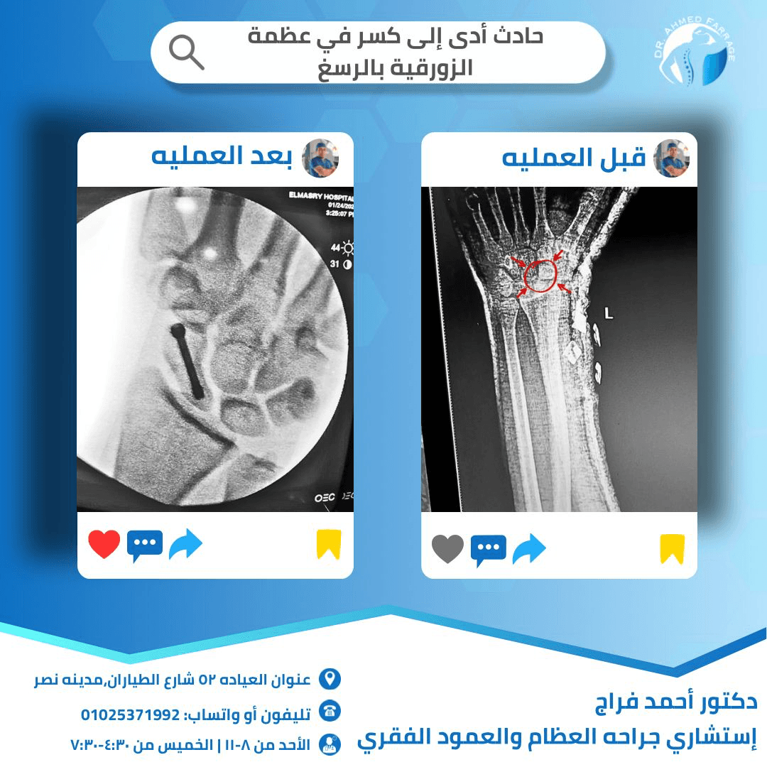 حادث أدي إلي كسر في عظمه الزورقيه