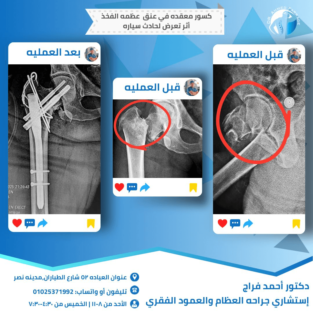 كسور معقده في عنق عظمه الفخذ أثر تعرض لحادث سياره