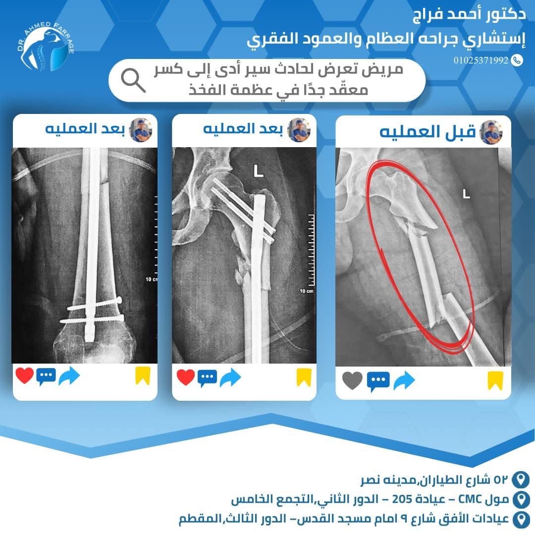 تعرض لحادث سير أدى إلى كسر معقّد جدًا في عظمة الفخذ